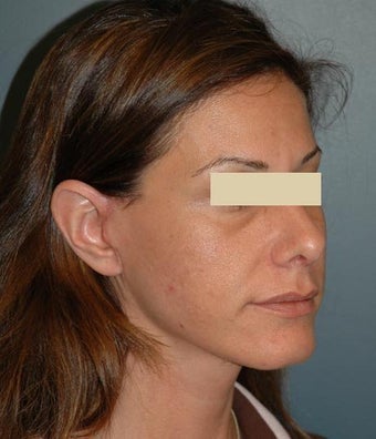 cheek lift after 137731