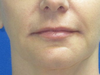 Juvederm chin and lip enhancement after 582251
