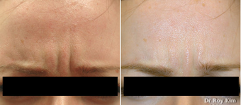 Botox before 273782