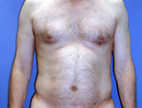 Male Liposuction of the back and abdomen before 125015