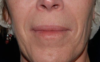 Nasolabial fold correction before 258481