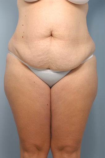 Tummy Tuck with Liposuction before 347794