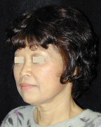 Facelift / Necklift before 103848