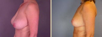 Breast Reduction before 271114