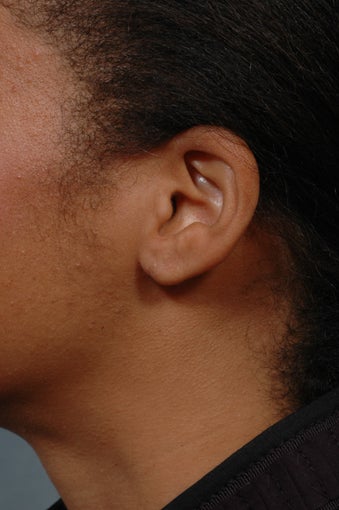 Earlobe Repair after 352442