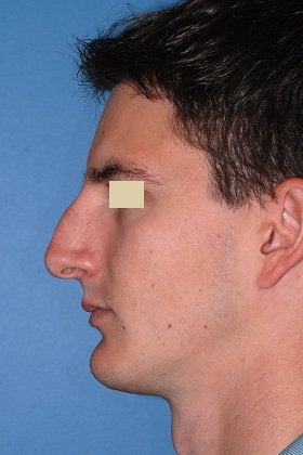 Rhinoplasty before 154300