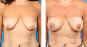 Breast Reconstruction: One-Stage Breast Reconstruction before 561811