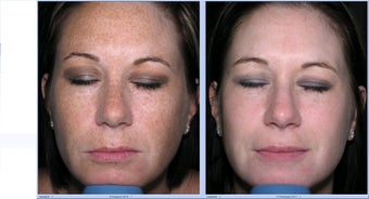 Limelight Ipl Treatment of the face before 315579