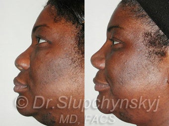 African American Rhinoplasty after 525577