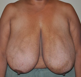 Breast Reduction before 530711