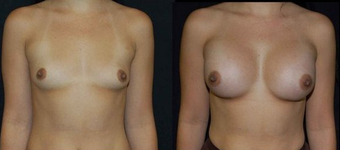 Breast Implants before 150821