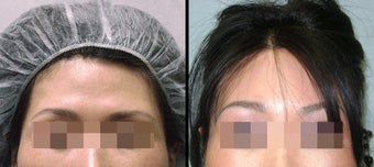 Endoscopic Brow Lift before 649394