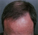 Hair Transplant after 426683