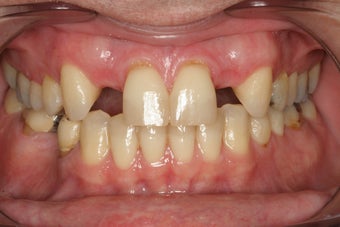 Implants Replacing Two Front Teeth before 167406