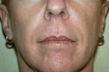 Radiesse and Juvederm XC after 281819