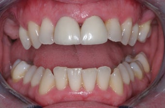 Invisalign, implants, whiteing and veneers before 372730
