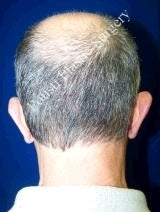 Ear Surgery (Otoplasty) before 584571