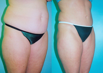 Tummy Tuck before 263628