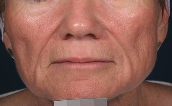 Fillers - Sculptra before 136191