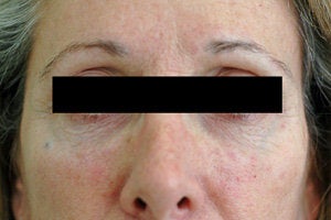 Restylane for dark circles under the eyes after 93362