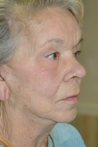 Medically Necessary Ptosis Repair of Both Upper Eyelids, Upper and Lower Cosmetic Eyelid Procedures, Endoscopic Forehead and Mid after 433470