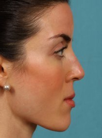 Revision Rhinoplasty 581089