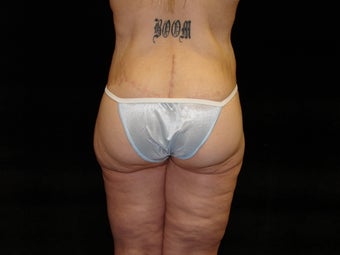 Body Lift, Outer Thigh Lift, Buttocks Lift after 203467