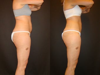 CoolSculpting before 576271