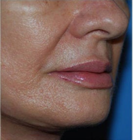 Fat Transfer / Fat Grafting / YoungVolumizer Procedure after 166182