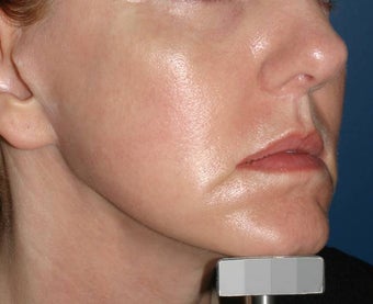 Fraxel Repair after 136853