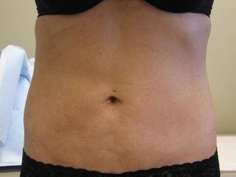 Lipotherme after 272091