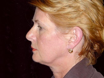 Facelift before 240017