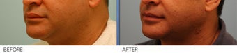 Male Upper Lip Reduction after 309222