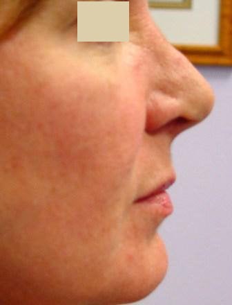 Radiesse Cheek Lift after 152204