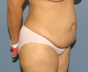 tummy tuck 527241