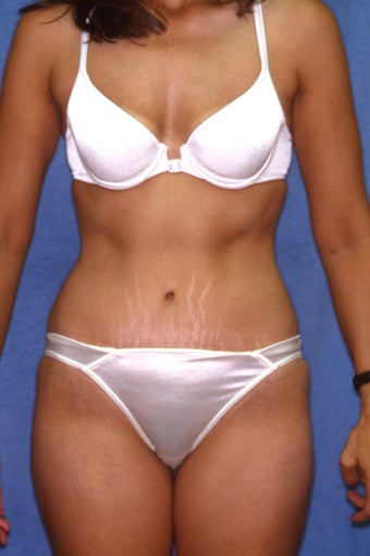 Tummy Tuck with Liposuction after 410983