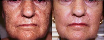 Laser resurfacing of the face and lips before 159579