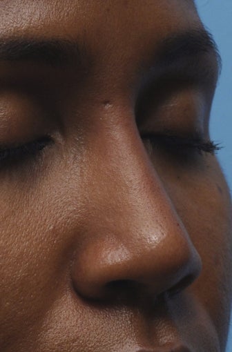 Non-Surgical Nose Job after 454046