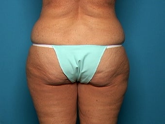 Liposuction after Age 50 before 138881