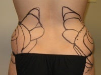 Liposuction before 272086