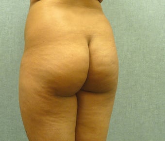 Brazilian Butt Lift before 392905