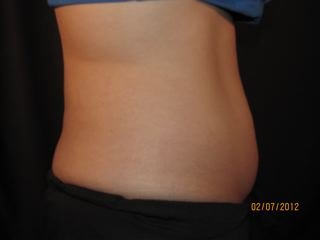Coolsculpting before 531062