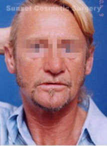 Ear Enhancement after 258222