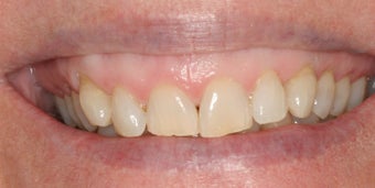 Orthodontics, all porcelain veneers, gum re-contouring before 503144