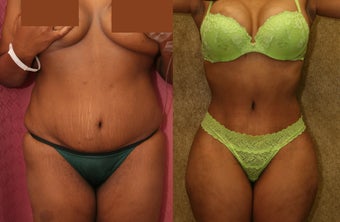 Tummy tuck revision before 230966