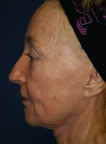 Sculptra Liquid Lift before 137175