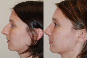 Rhinoplasty Surgery. 1 month post-op. before 210028