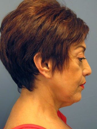Neck Lift, Platysmaplasty 634750