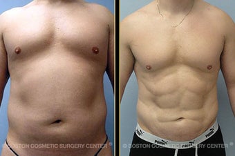 VASER LipoSelection and HiDef Liposculpture before 561141