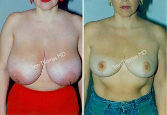 Breast Reduction before 243742